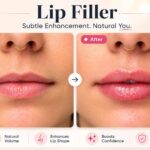 Side-by-side comparison showing lips before and after dermal filler treatment, with the after image displaying subtle increased volume, improved symmetry, and enhanced lip definition while maintaining a natural appearance.